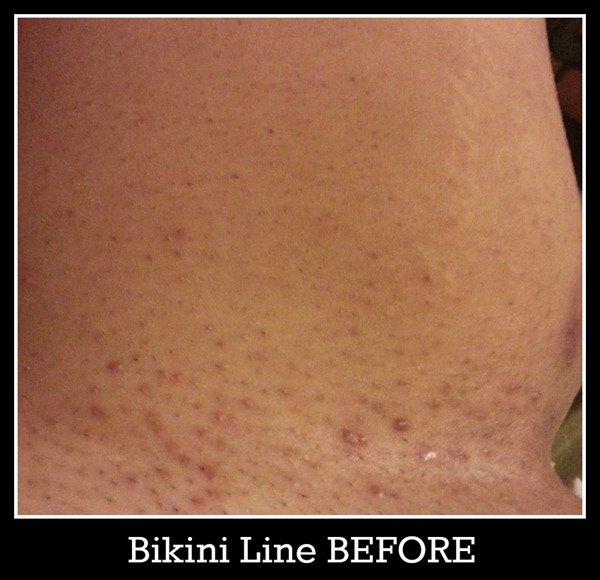 Bikini Line Razor Bumps 8